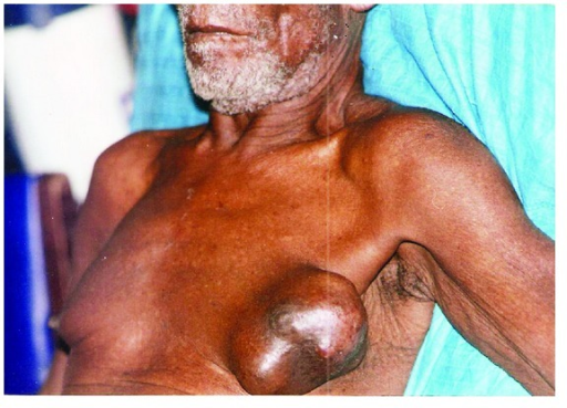 CANCER DU SEIN AU SÉNÉGAL : DERRIÈRE LE RUBAN ROSE, LES HOMMES AUSSI FRAPPÉS PAR LA MALADIE