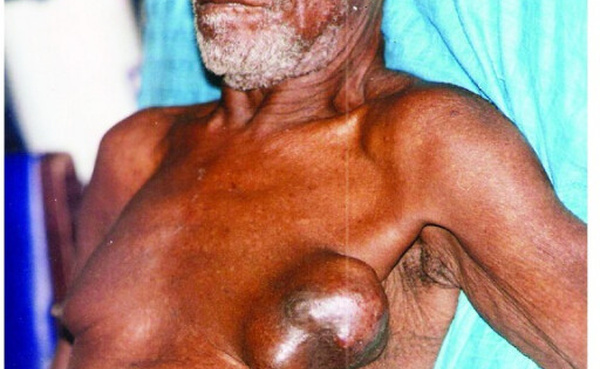 CANCER DU SEIN AU SÉNÉGAL : DERRIÈRE LE RUBAN ROSE, LES HOMMES AUSSI FRAPPÉS PAR LA MALADIE